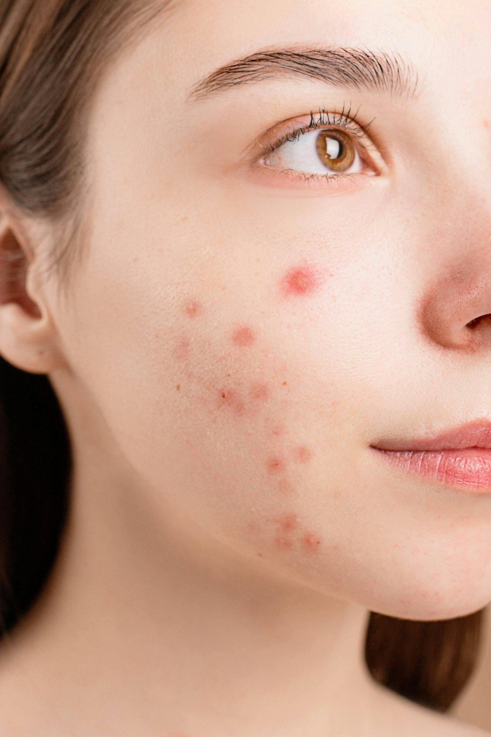 Dermatólogo en Alcobendas y La Moraleja · MontePediatras Dermatología adultos
